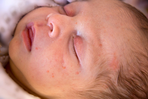 Baby Acne image